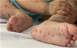 Bộ Y tế thông tin về thuốc điều trị bệnh tay chân miệng