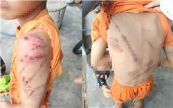 Công an thông tin việc bé trai bị bố đánh bầm tím chi chít