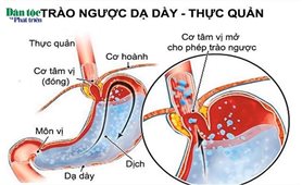 Trào ngược dạ dày thực quản: Nguyên nhân, triệu chứng, cách điều trị và phòng bệnh