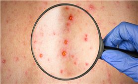 Cảnh báo nguy cơ zona thần kinh biến chứng nặng nếu không điều trị kịp thời