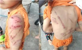 Công an thông tin việc bé trai bị bố đánh bầm tím chi chít