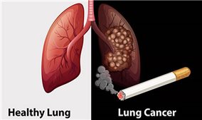SOS: Hơn 26.000 người Việt mắc ung thư phổi, 90% đều hút thuốc lá