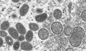 WHO đặt tên mới cho các chủng virus gây bệnh đậu mùa khỉ