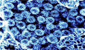 Virus gây bệnh COVID-19 có thể gây viêm não tương tự bệnh Parkinson