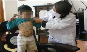 Ca mắc thủy đậu tăng cao, chủ yếu là trẻ mầm non và tiểu học