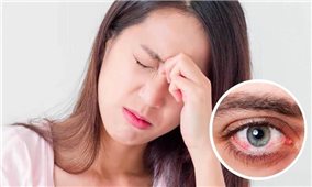 Cách phòng trị căn bệnh đau mắt đỏ