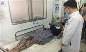 Không được chủ quan với bệnh thủy đậu