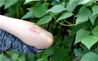 Giảm mẩn ngứa, rôm sảy từ cây lá trong vườn nhà