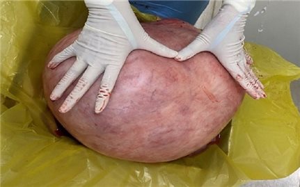 Phẫu thuật cắt bỏ khối u 11 kg của người phụ nữ 53 tuổi