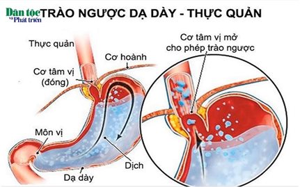 Trào ngược dạ dày thực quản: Nguyên nhân, triệu chứng, cách điều trị và phòng bệnh