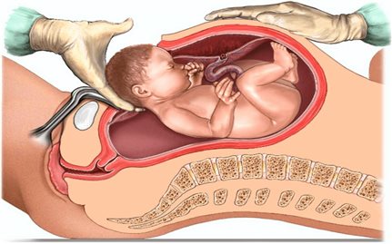 Mổ lấy thai chủ động: Cái giá của “ngày đẹp” có thể là sinh mạng