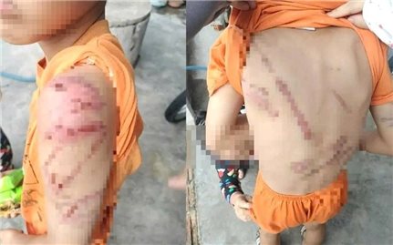 Công an thông tin việc bé trai bị bố đánh bầm tím chi chít