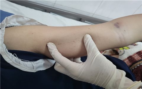Đắk Lắk: Đã có 9 trường hợp tử vong do sốt xuất huyết