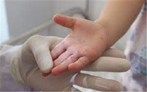 Đắk Lắk: Ghi nhận bệnh nhi đầu tiên tử vong do bệnh chân tay miệng