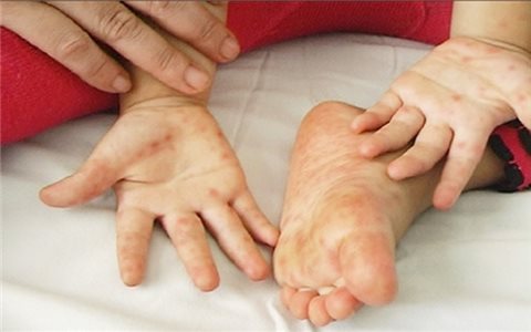 TP. Hồ Chí Minh: Cảnh báo Enterovirus 71 gây bệnh tay chân miệng nặng ở trẻ em xuất hiện trở lại