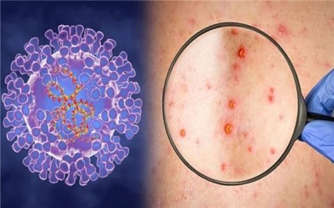 Ghi nhận ca bệnh đậu mùa khỉ đầu tiên ở Đồng Nai