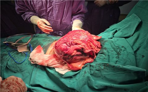 Gia Lai: Phẫu thuật thành công cho một phụ nữ Campuchia có khối u nặng 4 kg