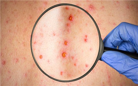 Cảnh báo nguy cơ zona thần kinh biến chứng nặng nếu không điều trị kịp thời