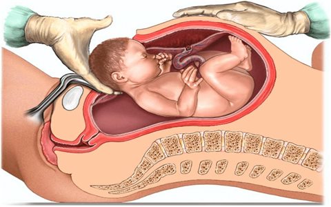 Mổ lấy thai chủ động: Cái giá của “ngày đẹp” có thể là sinh mạng