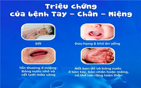 Khánh Hòa xuất hiện 21 ổ dịch tay chân miệng, tăng gấp 4 lần so với cùng kỳ