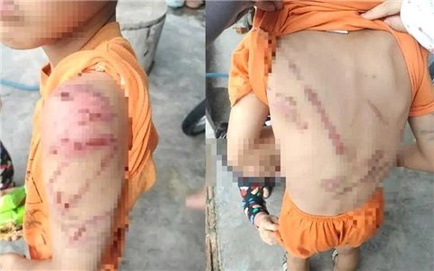 Công an thông tin việc bé trai bị bố đánh bầm tím chi chít