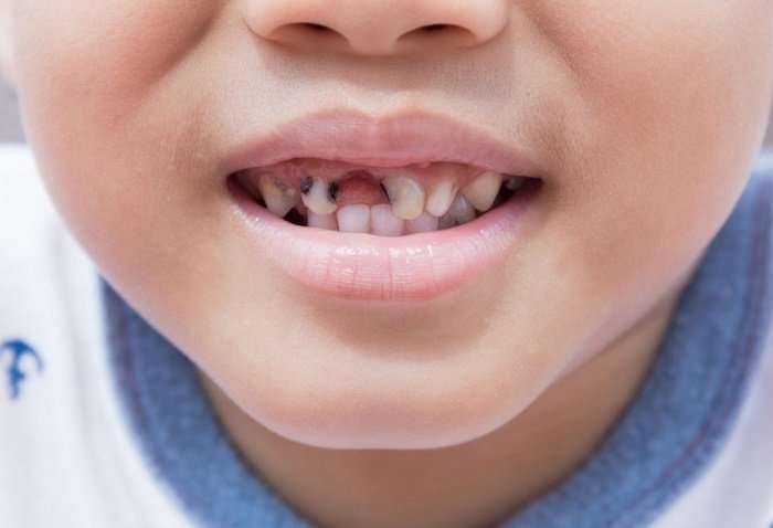 Nguyên nhân gây sâu răng ở trẻ và cách phòng tránh | Báo Dân tộc ...