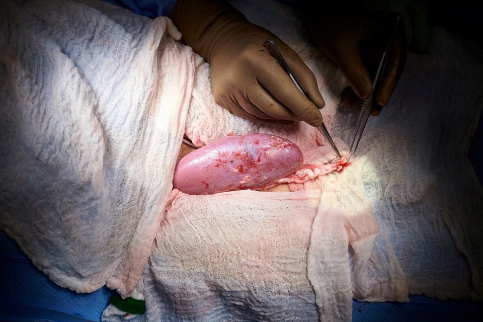 Quả thận lợn sau khi ghép với mạch máu người tiếp nhận được duy trì bên ngoài cơ thể bệnh nhân trong 3 ngày để các nhà nghiên cứu theo dõi. Ảnh: NYU/Reuters 