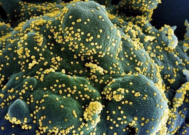 Một tế bào (xanh dương/xanh lục) bị nhiễm nặng các hạt virus SARS-CoV-2 (màu vàng), được phân lập từ mẫu của bệnh nhân COVID-19. (Ảnh: AFP/TTXVN)