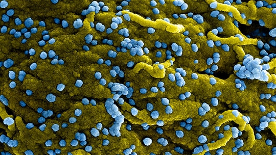 Hình ảnh hiển vi điện tử quét màu của các hạt virus Marburg (màu xanh lam) dính vào bề mặt của các tế bào VERO E6 bị nhiễm bệnh (màu vàng). Ảnh: Getty Images