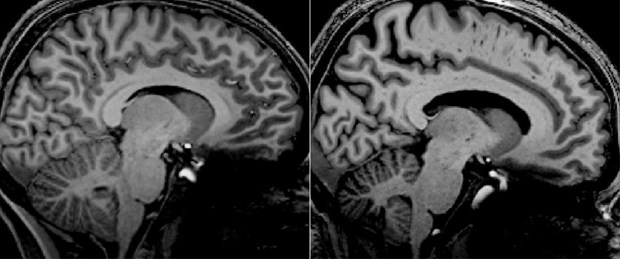 Hình ảnh chụp MRI não của bệnh nhân mắc COVID kéo dài (trái) và ME/CFS (phải). (Nguồn: news.griffith.edu.au)