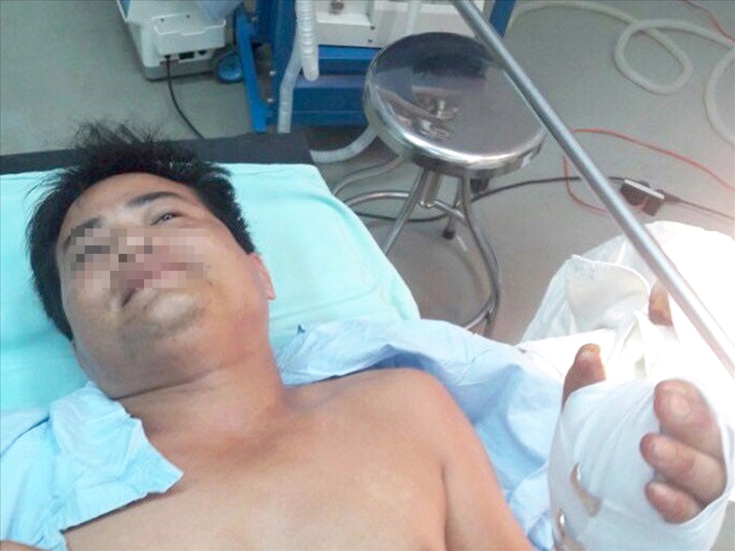Anh Nguyễn Văn Hùng ở Đồng Nai bị thương nặng ở tay do vô tình nghịch “súng bút”