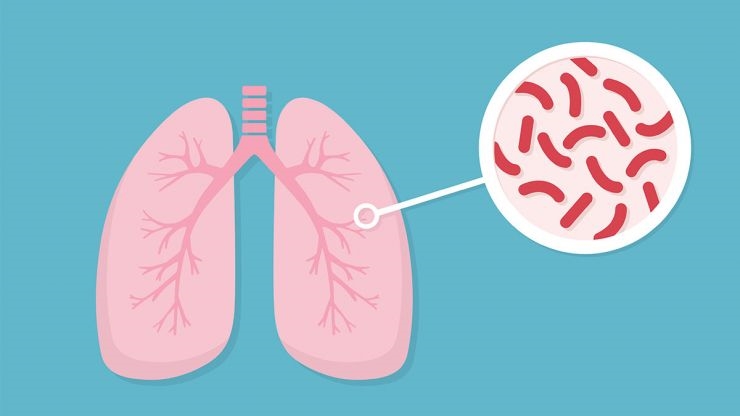 (Tổng hợp) Bệnh lao phổi, hiểm họa khôn lường cần lưu ý 4