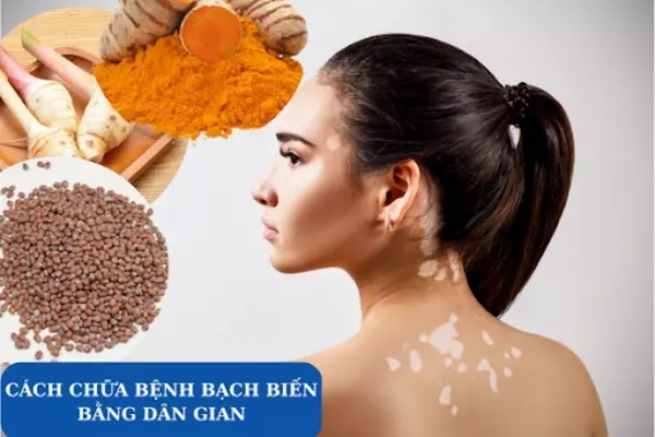 (Tổng hợp) Bệnh bạch biến-những điều bạn chưa biết 4