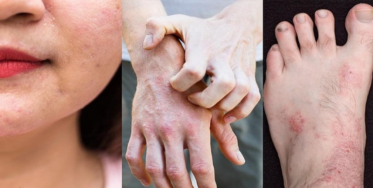 (Tổng hợp) Chế độ dinh dưỡng cho người viêm da cơ địa 4