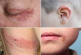 (Tổng hợp) Cảnh báo nguy cơ zona thần kinh biến chứng nặng nếu không điều trị kịp thời 2