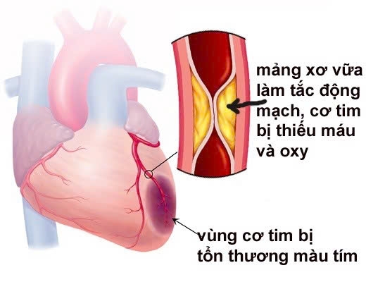 Nhồi máu cơ tim có thể xảy ra bất ngờ, nhưng có những trường hợp được cảnh báo trước hàng giờ