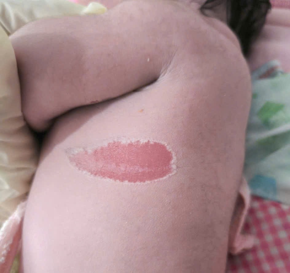 Một phần da em bé bị tổn thương do nắn bóp bụng để xoay thai (Ảnh Trung tâm Y tế Ayun Pa)