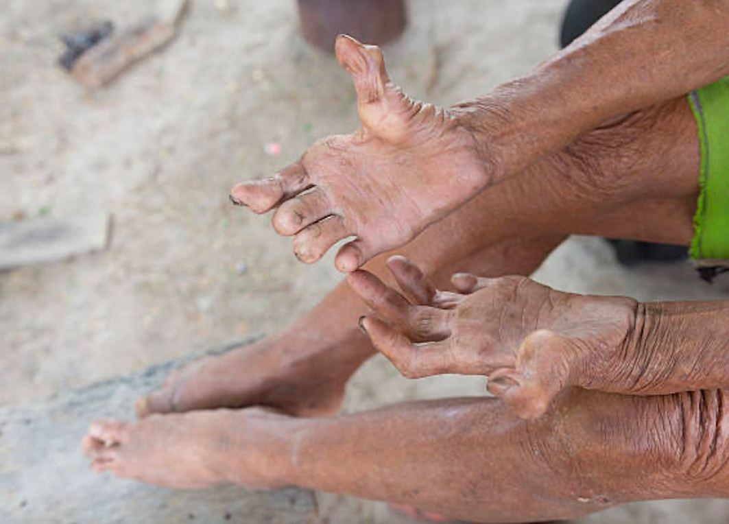Bệnh phong để lại nhiều di chức cho người bệnh. (Ảnh minh hoạ)