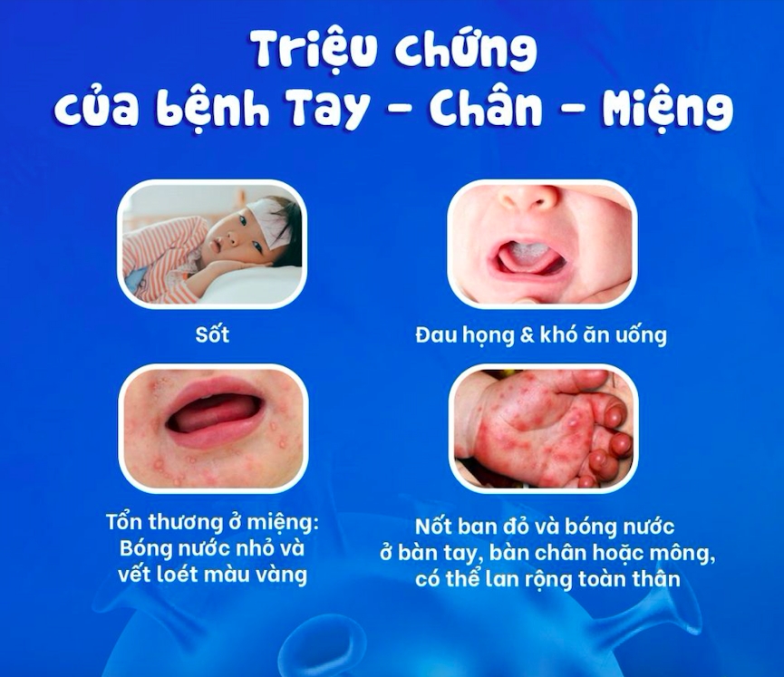 Những triệu chứng của bệnh tay chân miệng (Ảnh minh hoạ)